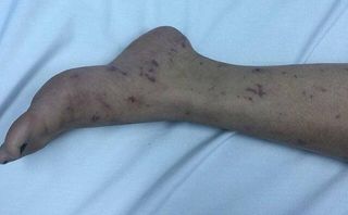 Hà Nội: Xuất hiện bệnh nhân bị viêm não mô cầu Hà Nội: Xuất hiện bệnh nhân bị viêm não mô cầu