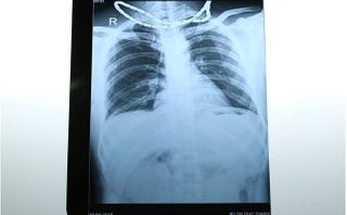 Cứu sống bệnh nhân bị đâm thấu bụng, thấu ngực Cứu sống bệnh nhân bị đâm thấu bụng, thấu ngực