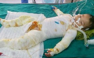 Gia cảnh éo le, bé trai 21 tháng tuổi rơi vào nồi nước sôi cần được giúp đỡ Gia cảnh éo le, bé trai 21 tháng tuổi rơi vào nồi nước sôi cần được giúp đỡ