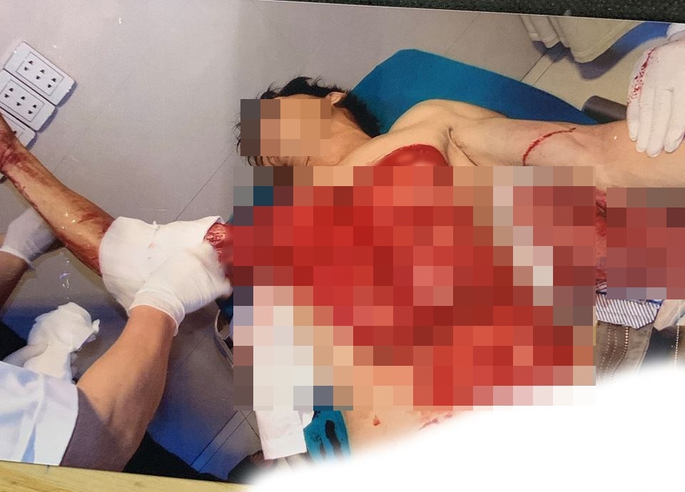 Sức khỏe - Ngã vào máy bóc gỗ, người đàn ông bị tai nạn thương tâm