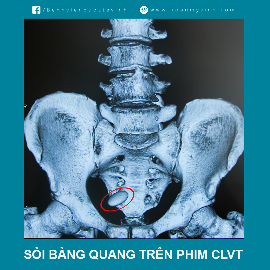 hinh anh soi bang quang tren phim clvt