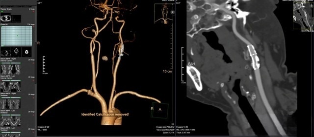 benh vien dk tp vinh ung dung may ctscanner 256 lat cat tam soat benh tim mach