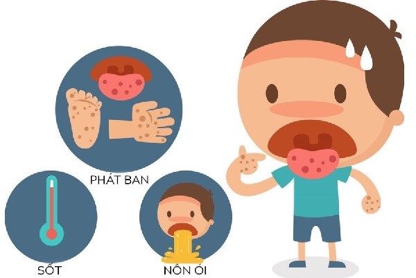 Sức khỏe - Đẩy lùi triệu chứng tay chân miệng hiệu quả nhờ bộ đôi thảo dược