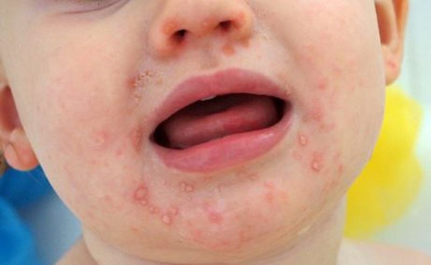 Sức khỏe - Đẩy lùi triệu chứng tay chân miệng hiệu quả nhờ bộ đôi thảo dược (Hình 2).