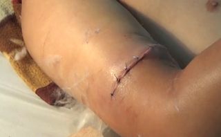 Bạc Liêu: Phẫu thuật nối thành công cánh tay bị đứt gần lìa Bạc Liêu: Phẫu thuật nối thành công cánh tay bị đứt gần lìa