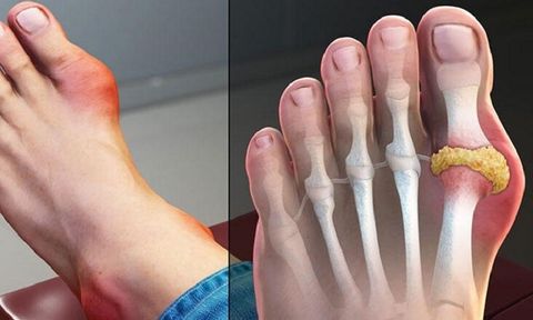 Đắp lá trộn muối chữa gout, nam bệnh nhân mất ngón chân