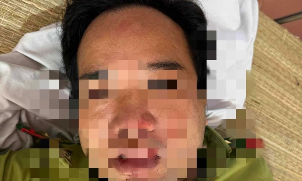 Ô tô chở lâm sản tông vào cán bộ kiểm lâm gây chấn thương