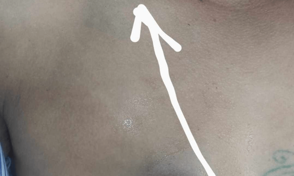 Người đàn ông bị 'đạn lạc' xuyên ngực